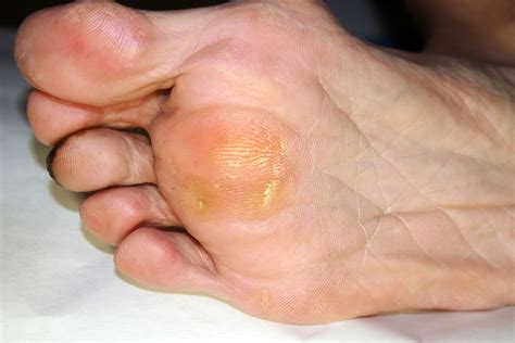 All You Need to Know About Painful Corns & Callous - Procare Podiatric Medicine & Surgery