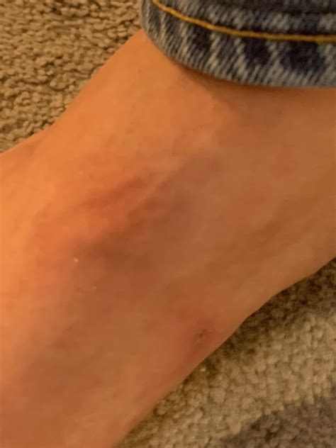 Worms?? Under my skin?? Circular raised tubes and they move around. Can someone identify? 🙏 : r ...