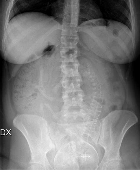 Abdominal radiography in woman with unrecognised pregnancy | BMJ Case ...