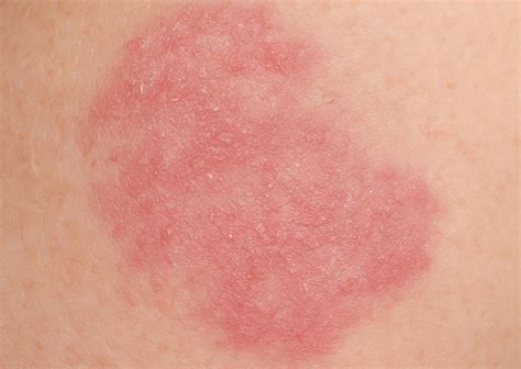 Dermatitis atópica en adultos: causas, síntomas y tratamiento - CIO Salud