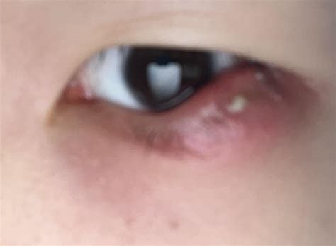 UPDATE: Small whitehead has grown on my swollen lower eyelid. Yellow discharge from corner of my ...