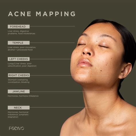 Acne Mapping | Acne mapping, Face mapping acne, Best acne treatment