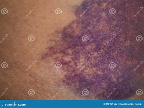 Bruise on the Buttock Skin Injury from Accident at Home Stock Image ...