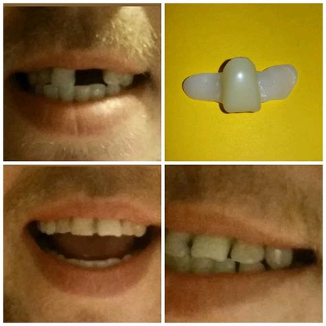 What Are Clip On Teeth at Janet Cantrell blog