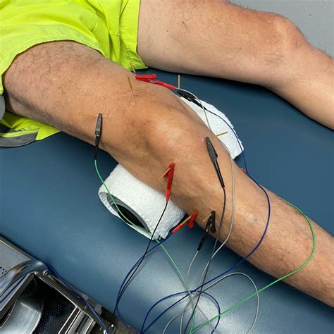 Orlando Dry Needling | Pursuit Physical Therapy