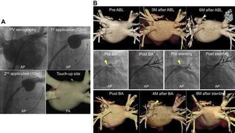 Severe pulmonary vein stenosis requiring angioplasty after hot balloon ...