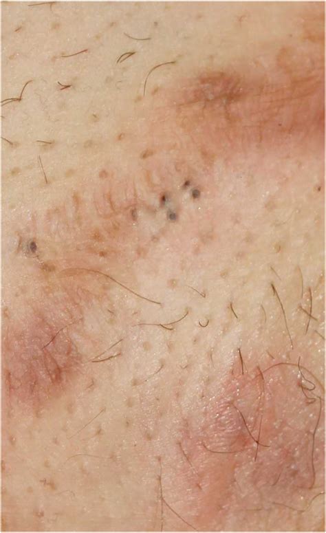 Hidradenitis Suppurativa Back