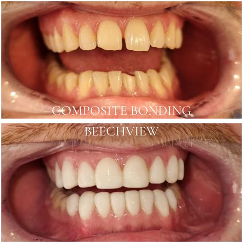 Composite Bonding in Blanchardstown | Beechview Dental