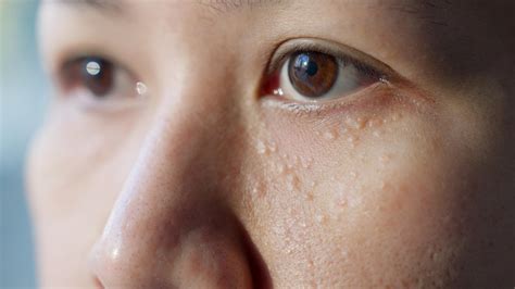 Milia: Causes and Treatment