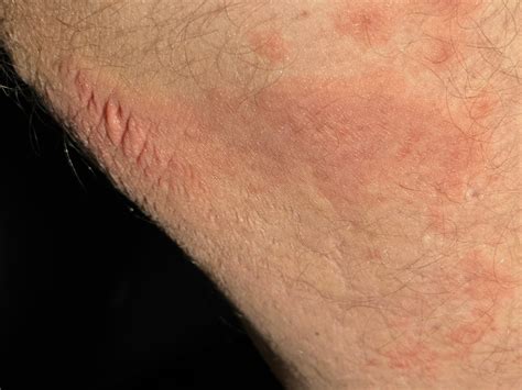 mycoplasma pneumonia : Howicured.org