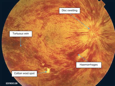 Cotton Wool Spots Retinal Vein Occlusion at Jorge Damon blog