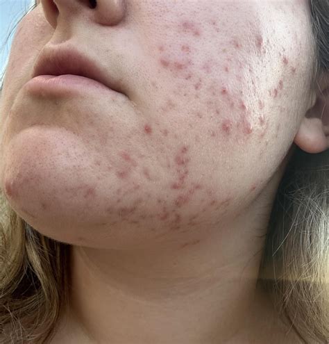hormonal cystic acne : r/SkincareAddicts