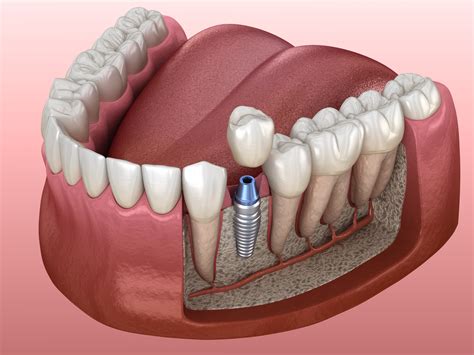 How Much Are Dental Implants For Top Teeth at Sandra Howard blog - dental implant images