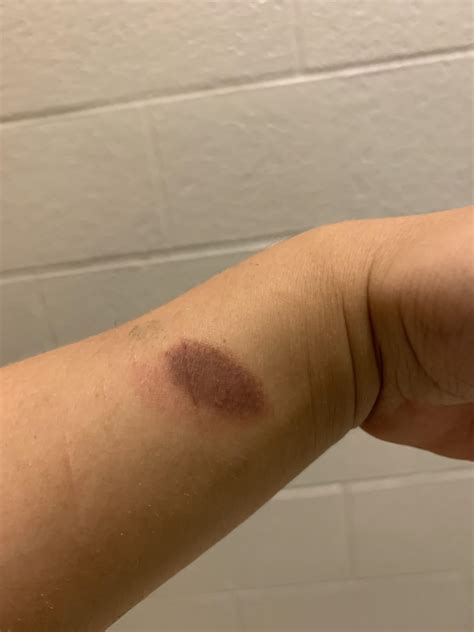 Why did my burn turn purple? : r/medical_advice