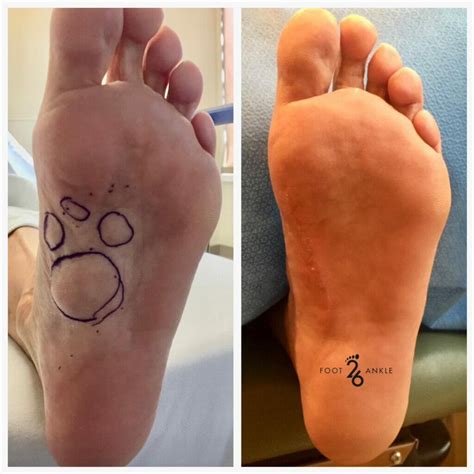 Soft Tissue Mass Removal: Plantar Fibroma - 26 Foot & Ankle
