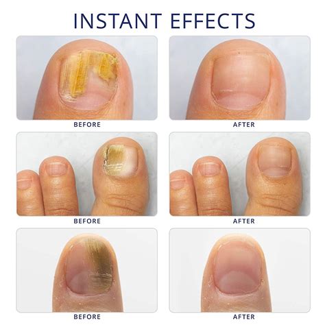 Toe Nail Fungus Treatment Clicks at Curtis Dolan blog