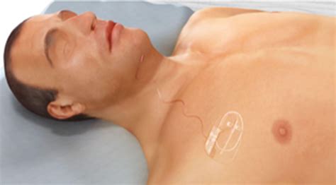 First UK hypoglossal nerve stimulation implant in the treatment for ...