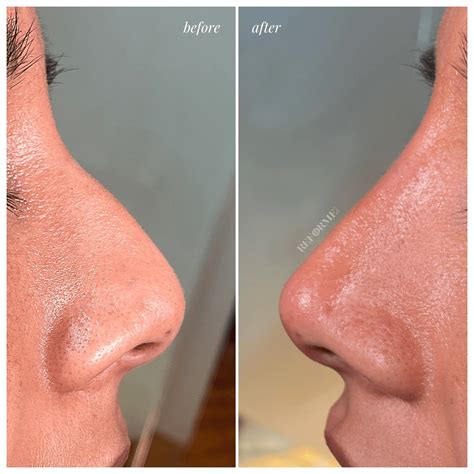 Non Surgical Rhinoplasty Toronto & Mississauga | Liquid Nose Job