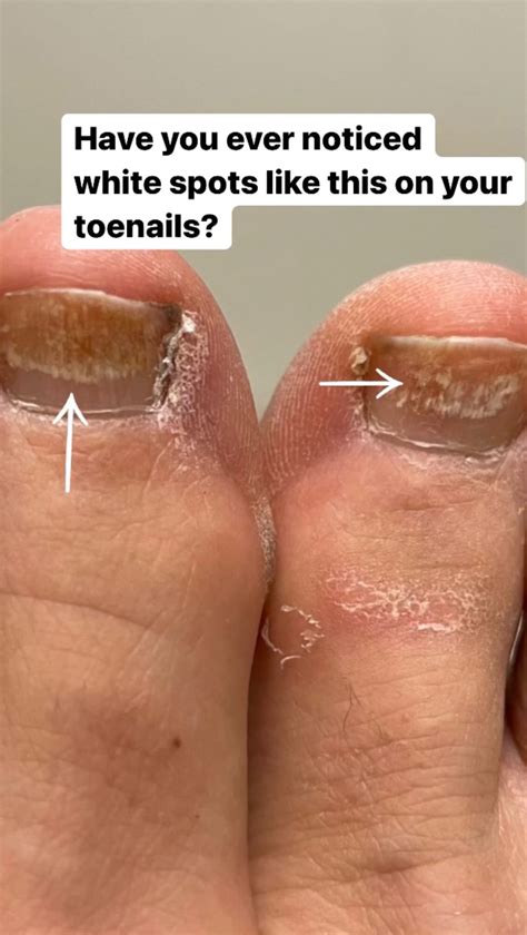 White Spots On Toenails