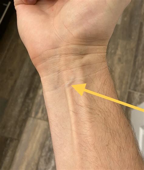 Wrist Pain And Bulging Vein at Dorothea Hunter blog