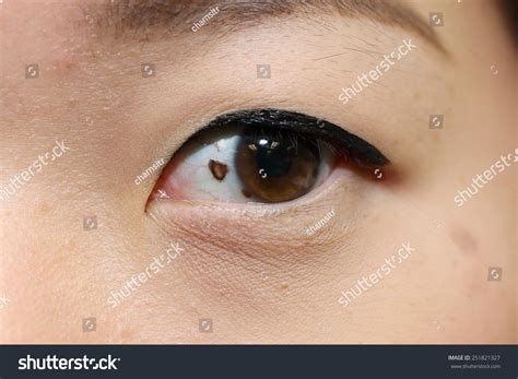 349 Melanoma Ojo Images, Stock Photos & Vectors | Shutterstock