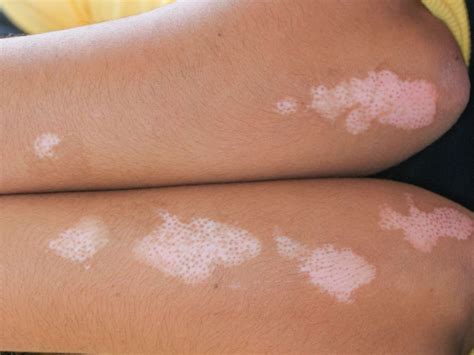White Spots On Skin White Spot On Skin Treatment, White Spot Treatment
