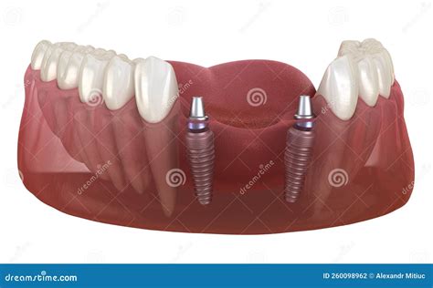 Frontal Teeth Bridge Supported By Implants. Medically Accurate 3D ...