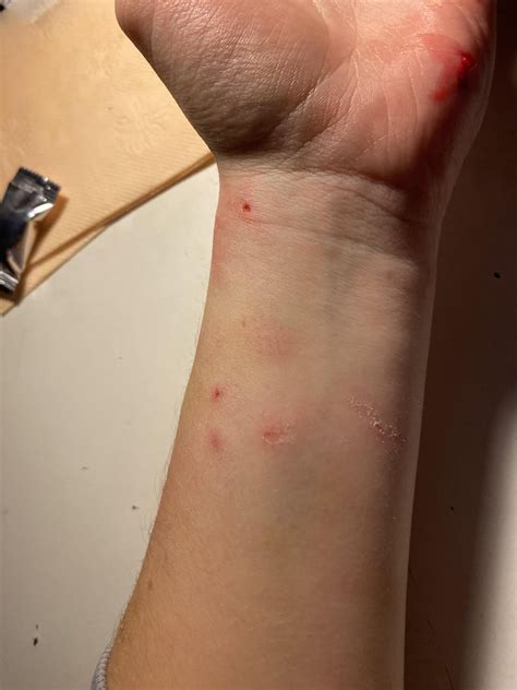 Got bitten by an akita three hours ago. What should I do? : r/medical ...