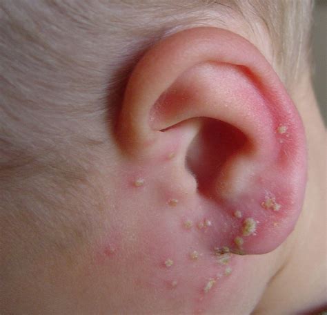 Crusty Behind Ears Causes, Symptoms, Dry Skin, Psoriasis, Skin Infections, Dermatitis and ...