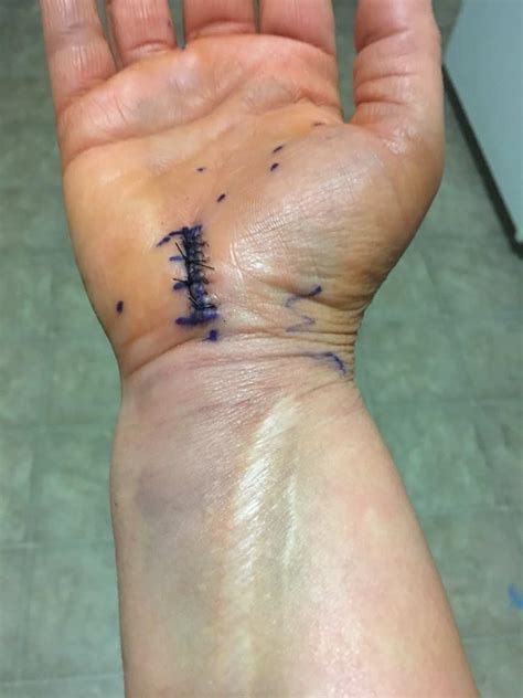 Carpal Tunnel Surgery Recovery: 3 Months Later - 24/7 Modern Mom™ | Simple Solutions for ...