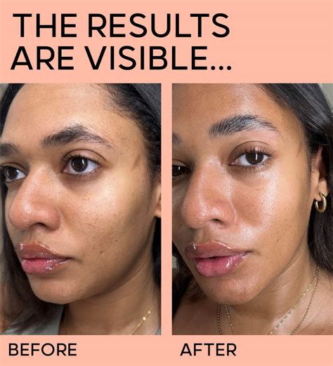 Moisture Barrier Skin Damage at Zenaida Williams blog