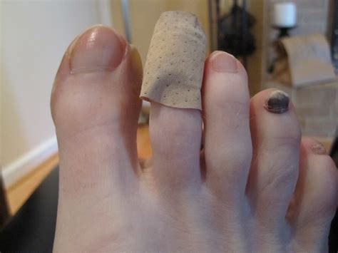 Blister On Toe Running Store | emergencydentistry.com