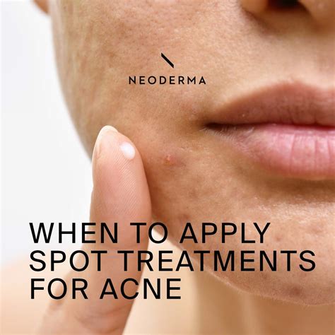 When to Apply Spot Treatments for Acne - NEODERMA