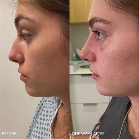 nose job recovery week by week - Jetta Sauer