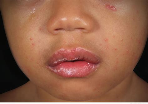 Gianotti Crosti Syndrome In Children