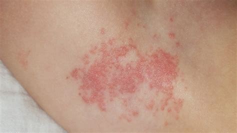 Shingles Rash Early Stages