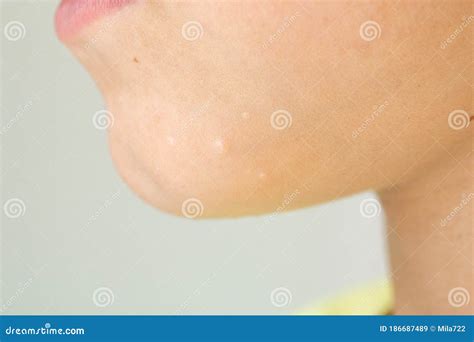 Close-up of Molluscum Contagiosum Also Called Water Wart. Viral ...