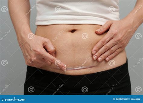 Woman Putting Healing Cream in C-section Scar of Cesarean Stock Image - Image of heal, caesarean ...