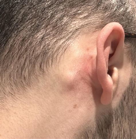 Becoming worried about a cyst behind the ear? : r/DermatologyQuestions