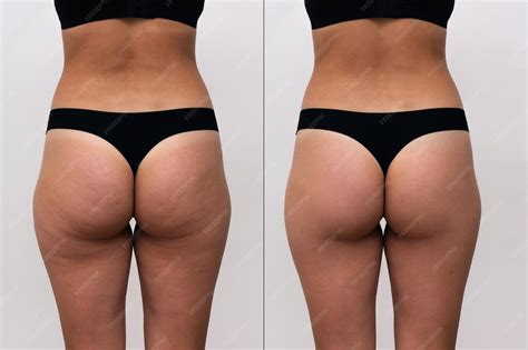 Premium Photo | Female buttocks with cellulite before and after anti-cellulite procedures sports ...