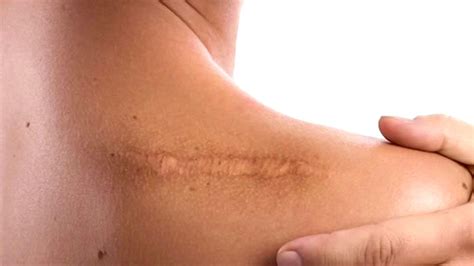 ¿Qué son las Cicatrices Queloides y Cómo Tratarlas? | N+ in 2025 ...