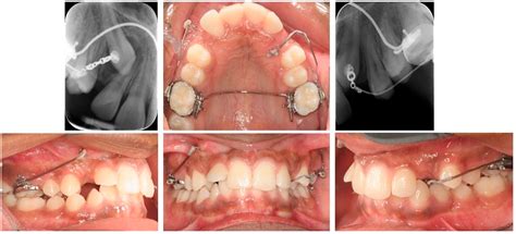 Buccal Canine Retractor Activation at June Blackwell blog