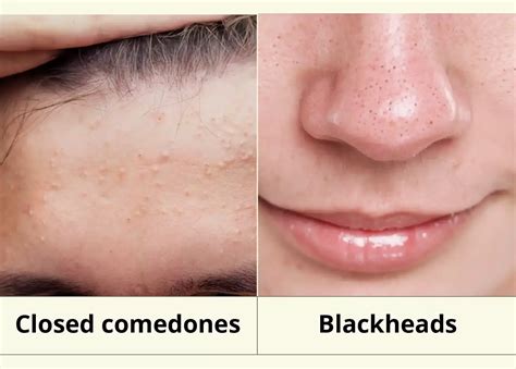 Closed Comedones Treatment