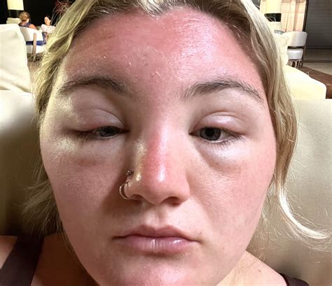 Holidaymaker left with sunburn so severe her own MUM couldn’t recognise her - What's The Jam