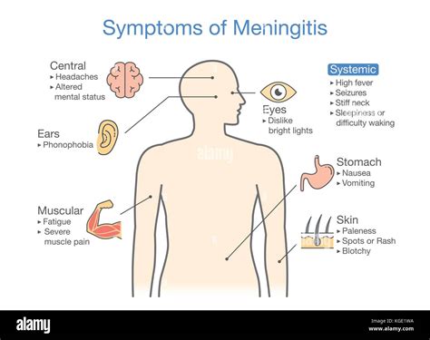 Diagram to showing patient symptoms with Meningitis disease Stock Vector Image & Art - Alamy