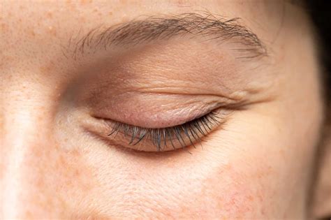 What Is Chemosis? Exploring Eye Swelling and How to Treat It - WorldHealth.net