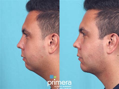 Buccal fat/ Cheek fat removal & Chin Implant in Orlando Florida