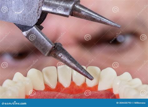 A Man Wants To Rip Out a Tooth with Forceps, View from Patient S Mouth ...
