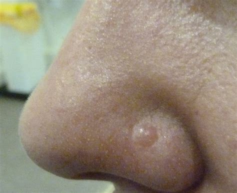 Basal Cell Carcinoma Pictures | Visual BCC Examples by Mr Tehrani
