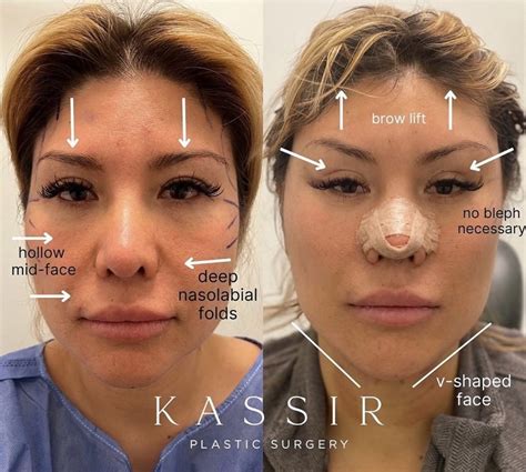 Cheek Lift Surgery